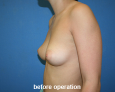 plastic-surgery-breast-augmentation
